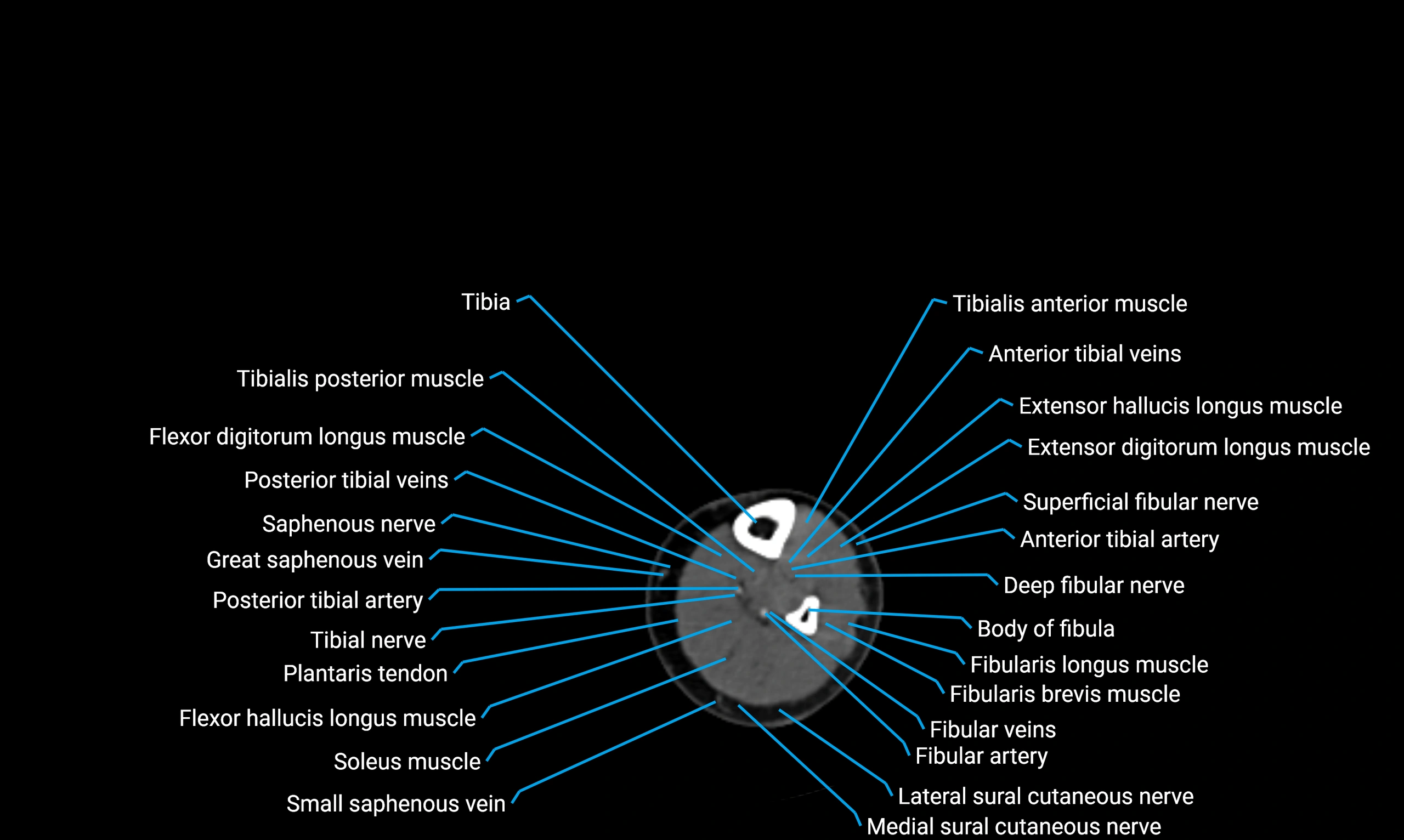 CT lower limb axial cross sectional anatomy labelled image 130 (2).webp